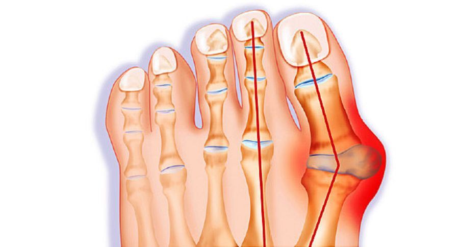 How To Treat Bunions?